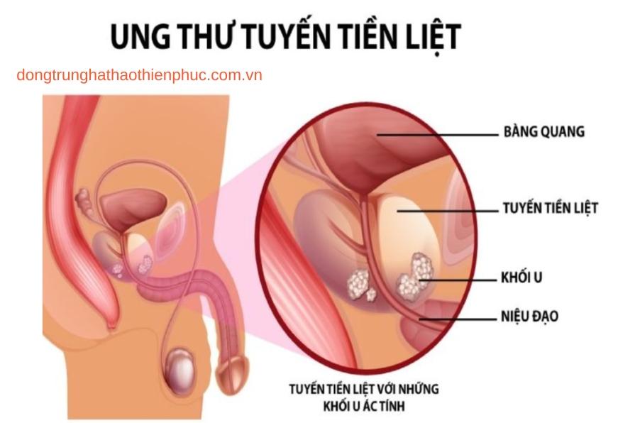 Nguyên nhân nguy cơ gây ung thư tuyến tiền liệt ở nam giới