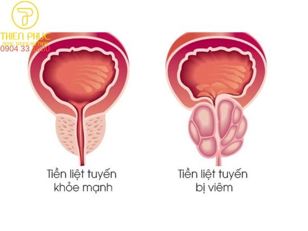 Viêm tiền liệt tuyến là tình trạng viêm nhiễm ở tuyến tiền liệt
