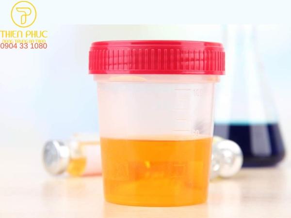 Nước tiểu có màu đục, đôi khi có máu là biểu hiện viêm tiền liệt tuyến