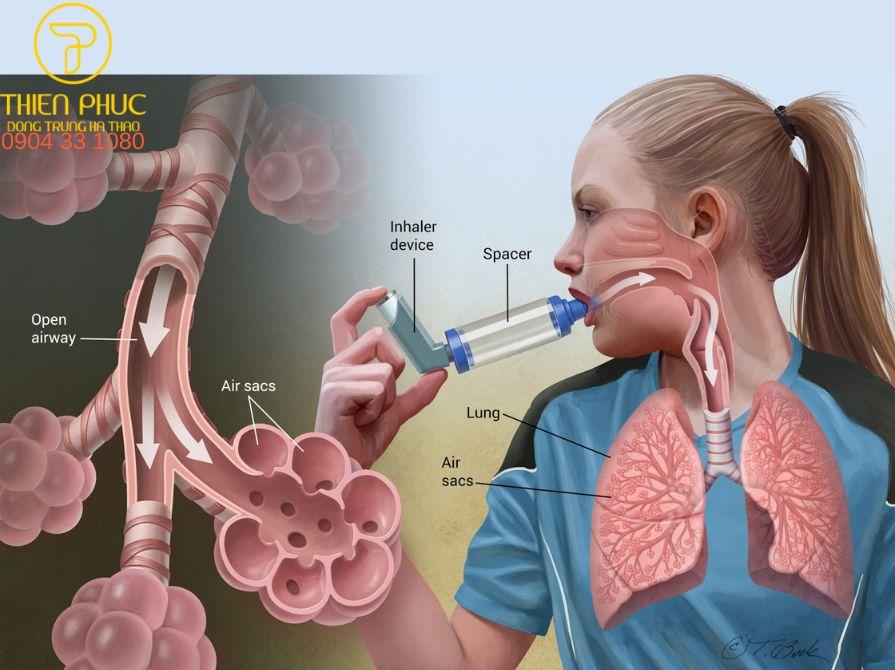 Hen suyễn mãn tính là một bệnh lý thường gặp về đường hô hấp