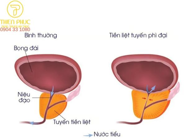 Phì đại tuyến tiền liệt