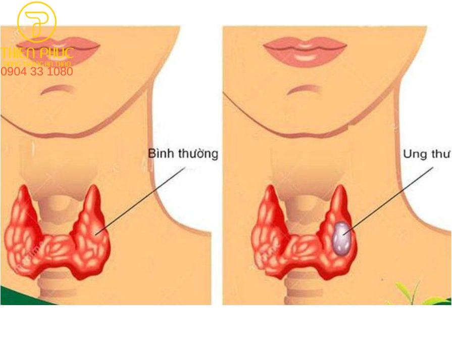 Ung thư tuyến giáp là một bệnh ung thư phổ biến