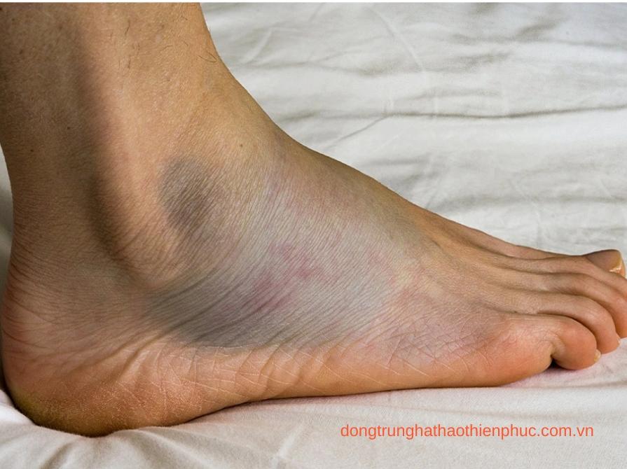 Biến chứng bàn chân ở tiểu đường