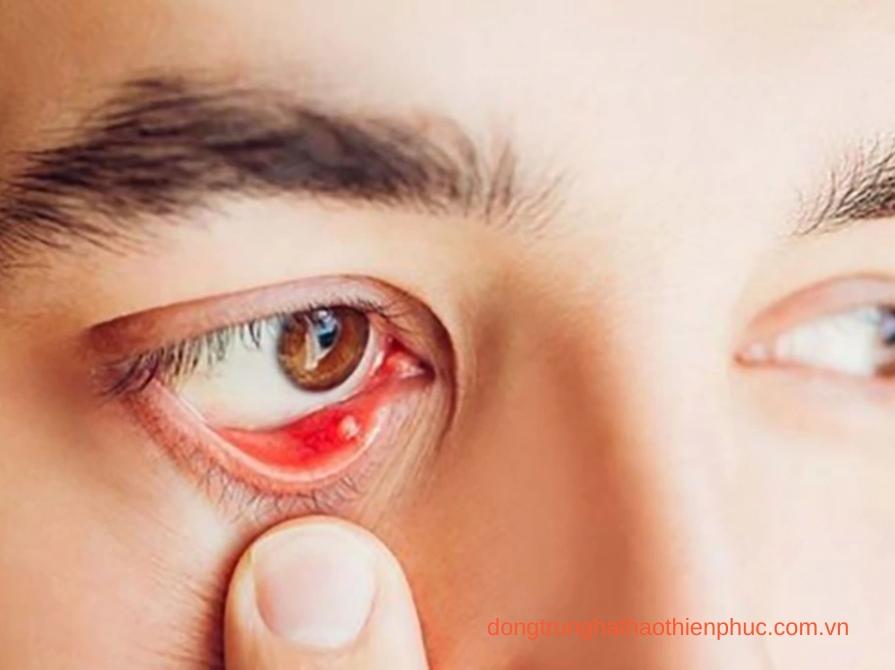 Bệnh tiểu đường gây tổn thương mắt