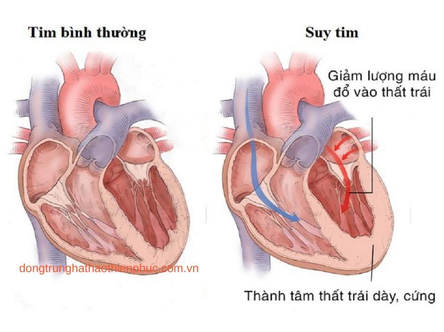 Dấu hiệu cảnh báo suy tim