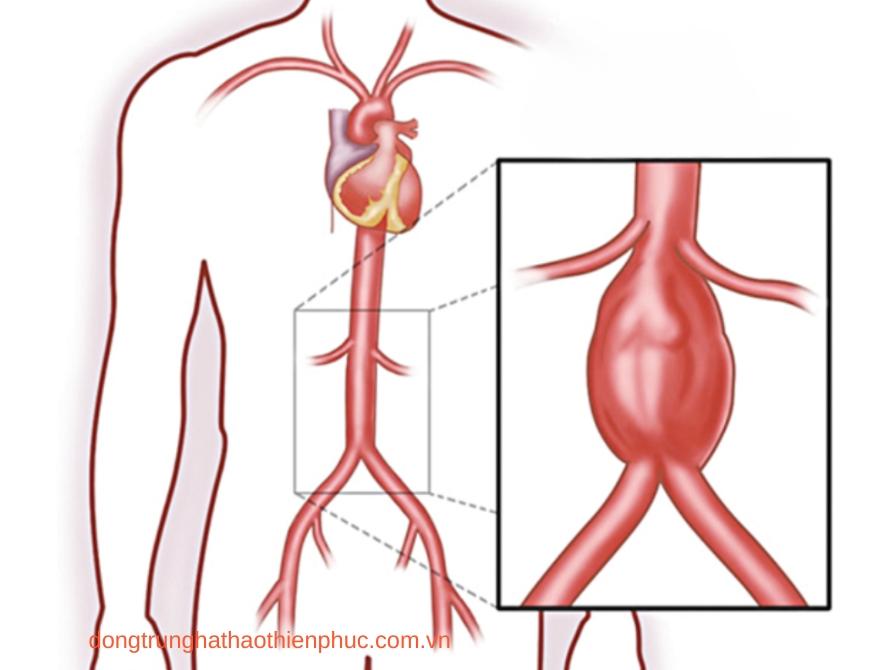 Cao huyết áp có thể làm phình động mạch