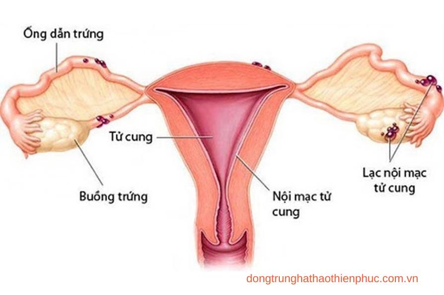 Hình ảnh lạc nội mạc tử cung