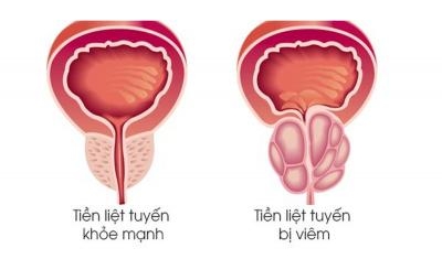 Bệnh viêm tiền liệt tuyến có nguy hiểm không – Nguyên nhân, triệu chứng và cách phòng ngừa